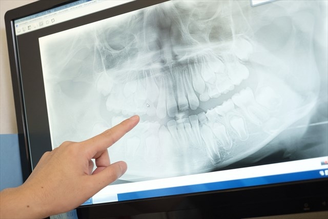 歯のレントゲン画像
