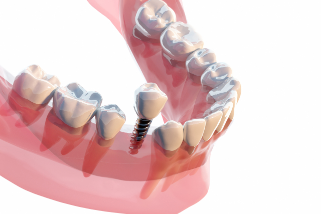 インプラントとは